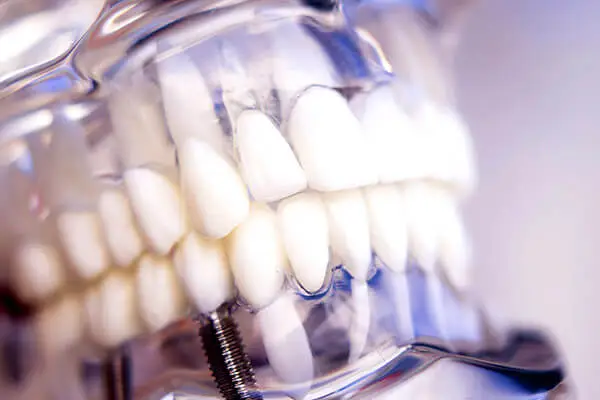 diş implant tedavisi
